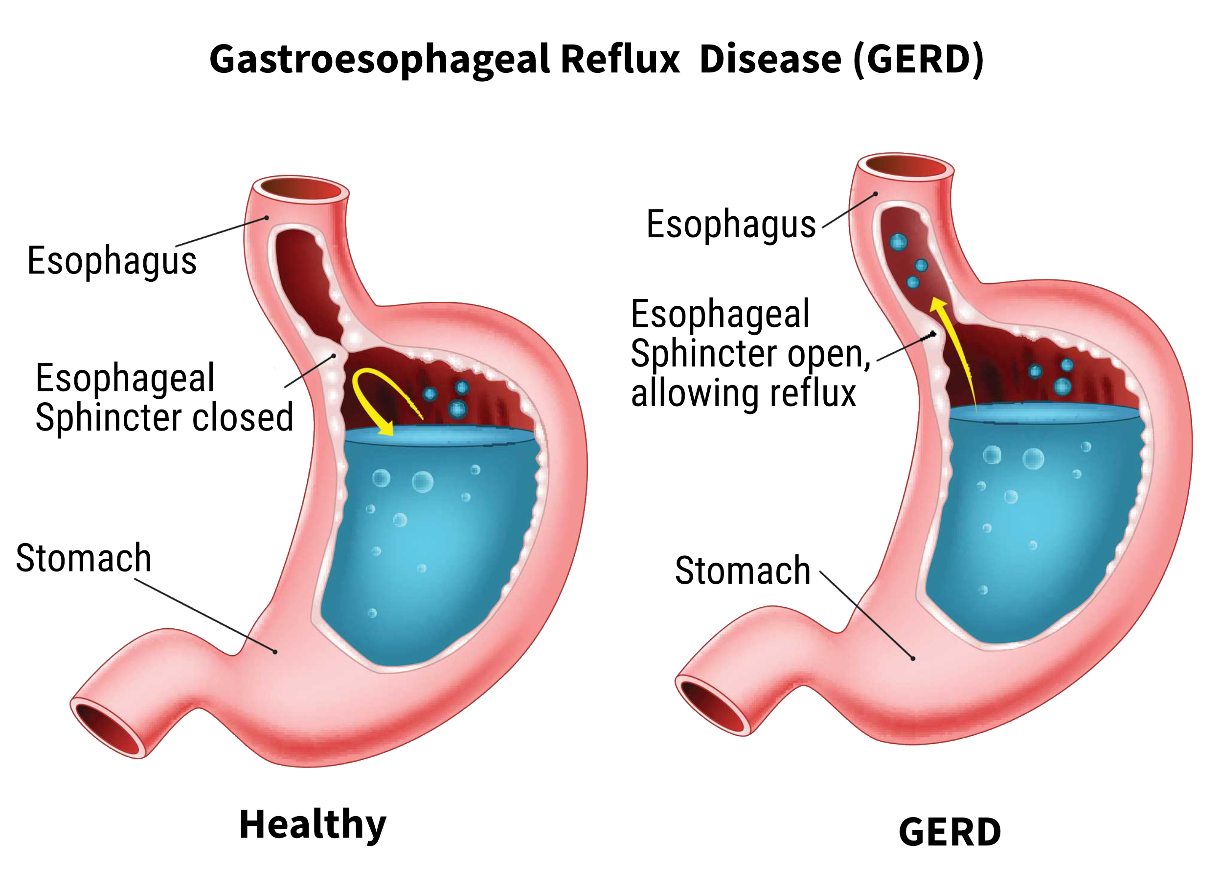 GERD ACID REFLUX ILLUSTRATION